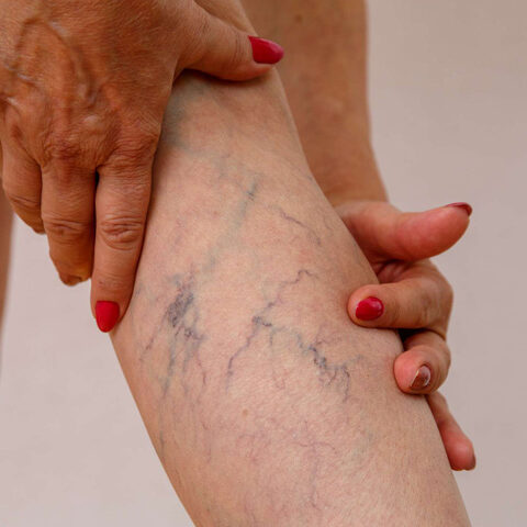 Varicose Veins Treatment in Pimple Saudagar