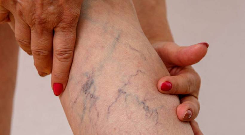 Varicose Veins Treatment in Pimple Saudagar